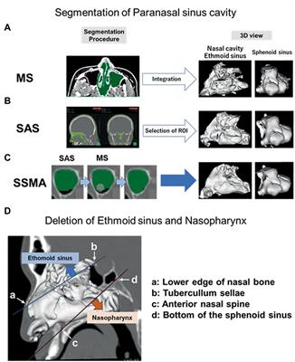 Volumetric measurement of paranasal sinuses and its clinical significance in pituitary neuroendocrine tumors operated using an endoscopic endonasal approach